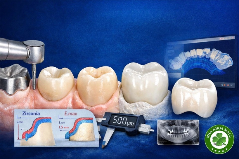 Vai trò của sửa soạn cùi răng trong độ bền lâu dài của mão sứ