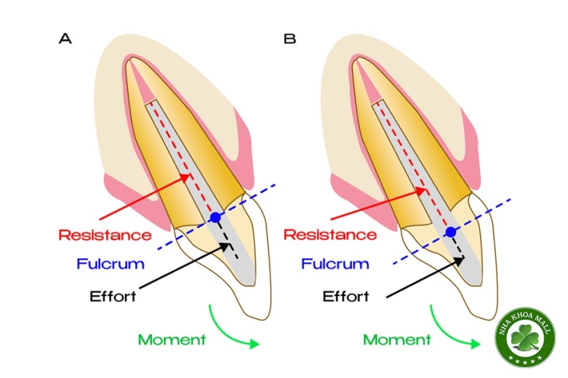 Hiệu ứng ferrule trong phục hồi răng đã điều trị nội nha