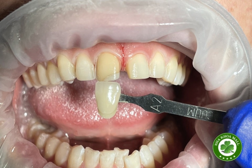 Các kỹ thuật trong chế tác mặt dán sứ tạm thời đơn lẻ