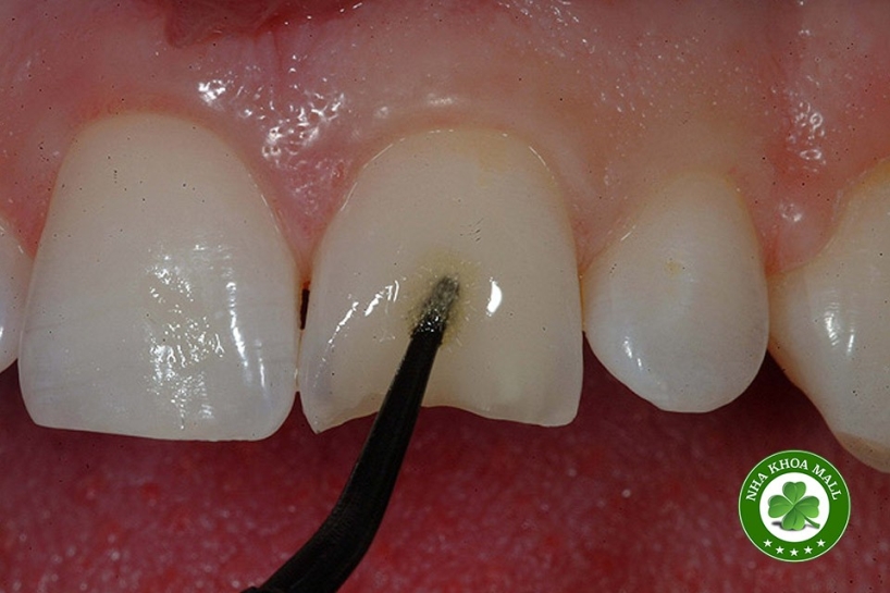 Bonding ngà răng: Những yếu tố ảnh hưởng đến độ bền lâu dài của phục hồi