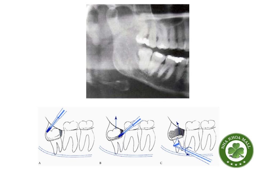 Chiến lược xử lý răng khôn mọc nghiêng xa - Hướng dẫn phẫu thuật chi tiết
