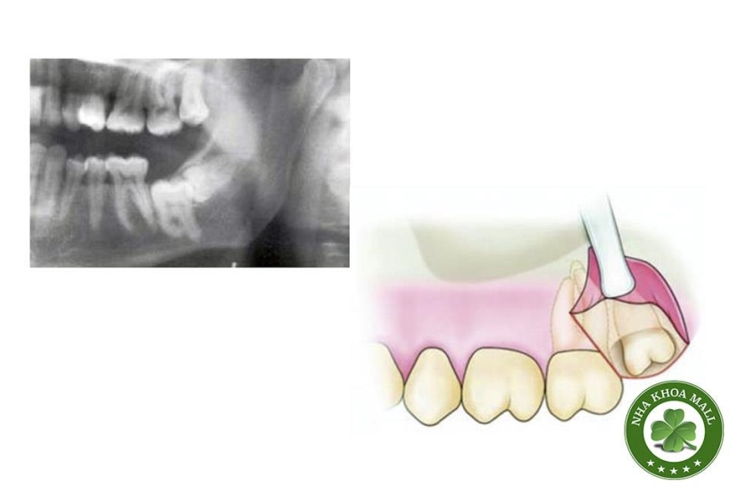 Tiểu phẫu răng khôn hàm trên: Đặc điểm, quy trình và những lưu ý quan trọng