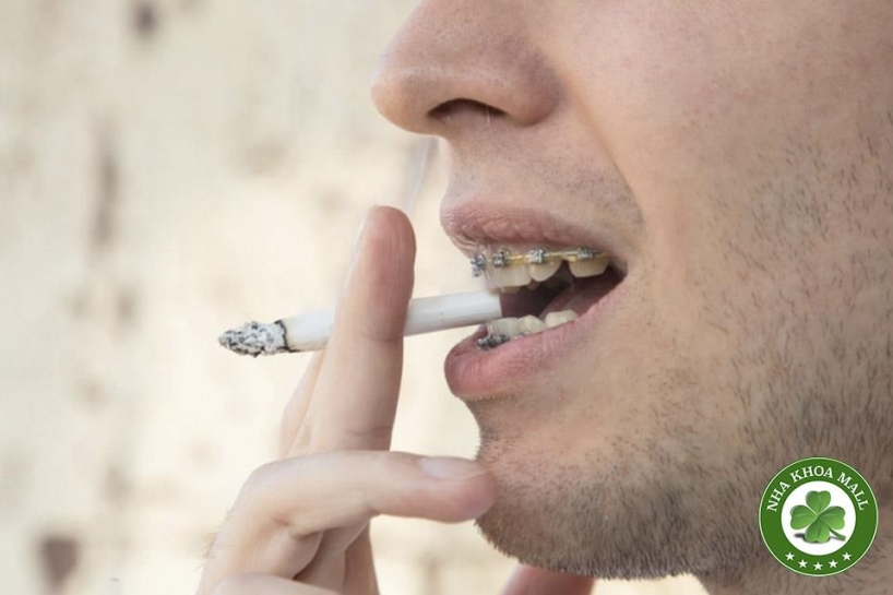 Hút thuốc khi đang niềng răng -Mối nguy hiểm thầm lặng mà bạn cần biết!