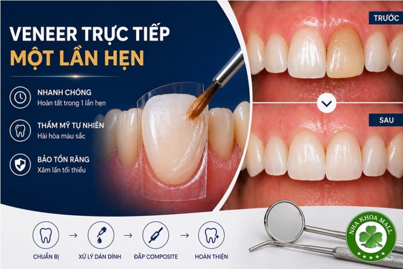 Composite phổ quát và veneer trực tiếp: Giải pháp tối ưu một lần hẹn cho phục hồi răng trước