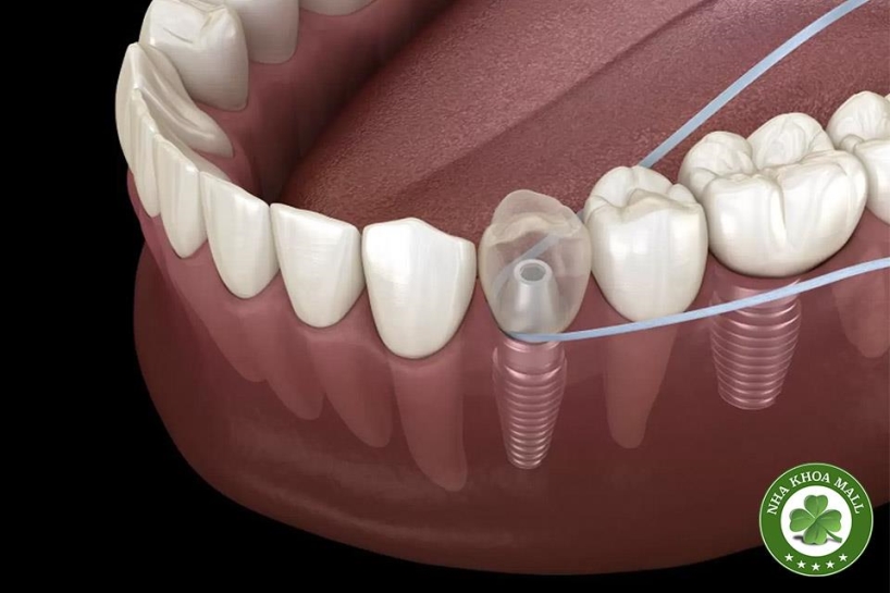 Chăm sóc răng implant: Kết hợp giữa Bác Sĩ và ý thức bệnh nhân