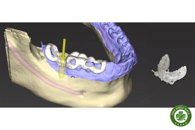 Vai trò của CBCT và máng hướng dẫn phẫu thuật trong cấy ghép implant