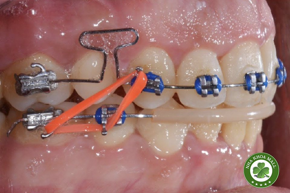 Phân tích hệ thống về loop chỉnh nha, loop dọc, loop chữ T và loop chữ L