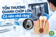 Tổn thương quanh chóp lớn: Khi nào nên điều trị bảo tồn thay vì nhổ răng?