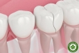 Bruxism Là Gì? Cách Chẩn Đoán Và Điều Trị Răng Nứt Do Nghiến Răng Hiệu Quả