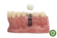 Nguyên tắc vàng khi tái cấy implant sau thất bại