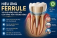 Hiệu ứng Ferrule Và Khả Năng Phục Hồi Răng Tổn Thương Nặng