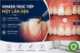 Composite phổ quát và veneer trực tiếp: Giải pháp tối ưu một lần hẹn cho phục hồi răng trước