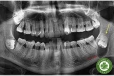 Phẫu thuật lấy mầm răng khôn (R8): Chỉ định, thời điểm và kỹ thuật thực hiện