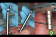 Sai số trên cây đo lực torque implant nha khoa: Nguyên nhân gây lỏng vít và giải pháp