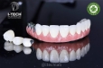 Phục hình Thimble Bar All-on-4 in 3D Cr-Co: Giải pháp cho phục hình toàn hàm trên implant