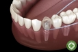 Chăm sóc răng implant: Kết hợp giữa Bác Sĩ và ý thức bệnh nhân