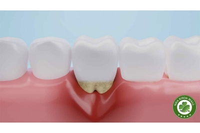 Cách phát hiện và loại bỏ cao răng đã được mài bóng cứng đầu