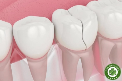 Bruxism Là Gì? Cách Chẩn Đoán Và Điều Trị Răng Nứt Do Nghiến Răng Hiệu Quả