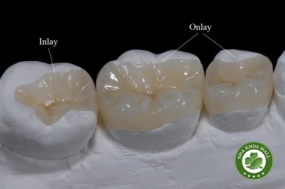 Mão răng Onlay là gì? Ưu điểm và quy trình phục hồi răng bảo tồn cấu trúc tự nhiên