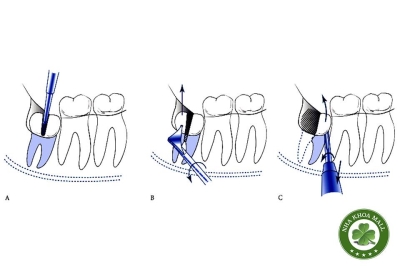 Tiểu phẫu răng khôn mọc thẳng đứng: Đánh giá và kỹ thuật thực hiện Tiểu phẫu răng khôn mọc thẳng đứng: Đánh giá và kỹ thuật thực hiện