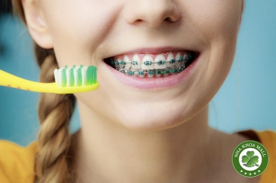 4 Mẹo Vàng Giúp Ngăn Ngừa Sâu Răng Khi Đeo Mắc Cài Niềng Răng