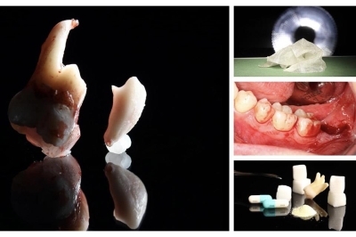Quy trình phẫu thuật răng khôn: những nguyên tắc cơ bản