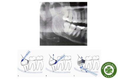 Chiến lược xử lý răng khôn mọc nghiêng xa - Hướng dẫn phẫu thuật chi tiết Chiến lược xử lý răng khôn mọc nghiêng xa - Hướng dẫn phẫu thuật chi tiết