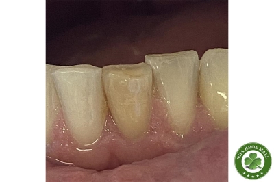 Chẩn đoán và điều trị răng cửa đổi màu không rõ nguyên nhân (UDAT)