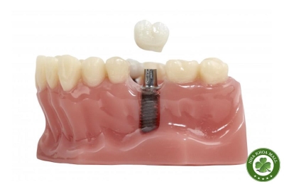 Nguyên tắc vàng khi tái cấy implant sau thất bại