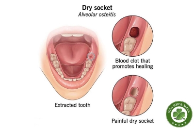 Viêm huyệt ổ răng khô sau nhổ răng: Dấu hiệu, nguyên nhân và cách xử lý hiệu quả