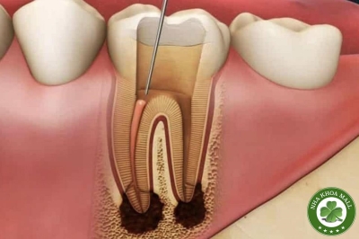 Nguyên Nhân Gây Thất Bại Trong Điều Trị Tủy – Đặc Biệt Là Đau Sau Điều Trị