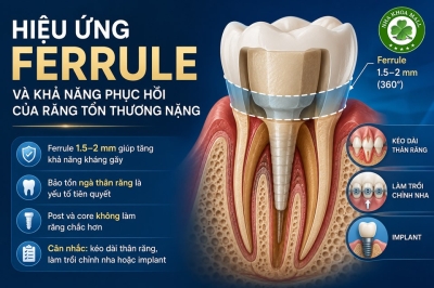 Hiệu ứng Ferrule Và Khả Năng Phục Hồi Răng Tổn Thương Nặng