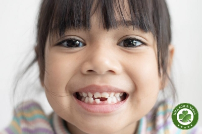 Thiếu răng bẩm sinh (Hypodontia): Nguyên nhân, Biến chứng và Hướng điều trị