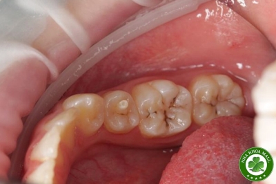 Xử lý núm phụ mặt nhai Dens Evaginatus 