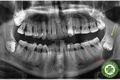 Phẫu thuật lấy mầm răng khôn (R8): Chỉ định, thời điểm và kỹ thuật thực hiện
