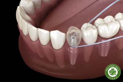 Chăm sóc răng implant: Kết hợp giữa Bác Sĩ và ý thức bệnh nhân