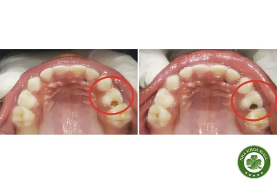 Ứng dụng Silver Diamine Fluoride (SDF) trong kiểm soát sâu răng kẽ: Kỹ thuật, cơ chế và bằng chứng lâm sàng