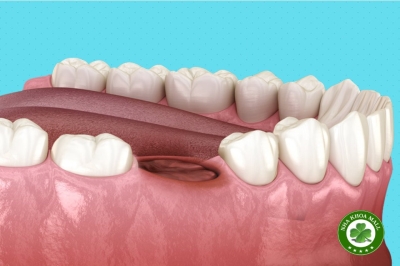 Phòng ngừa viêm huyệt ổ răng khô bằng băng Polyox: Giải pháp hỗ trợ lành thương sau nhổ răng