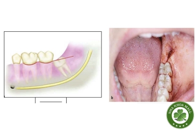 Tiểu phẫu răng khôn R8 mọc nghiêng gần: Hướng dẫn đánh giá và xử lý